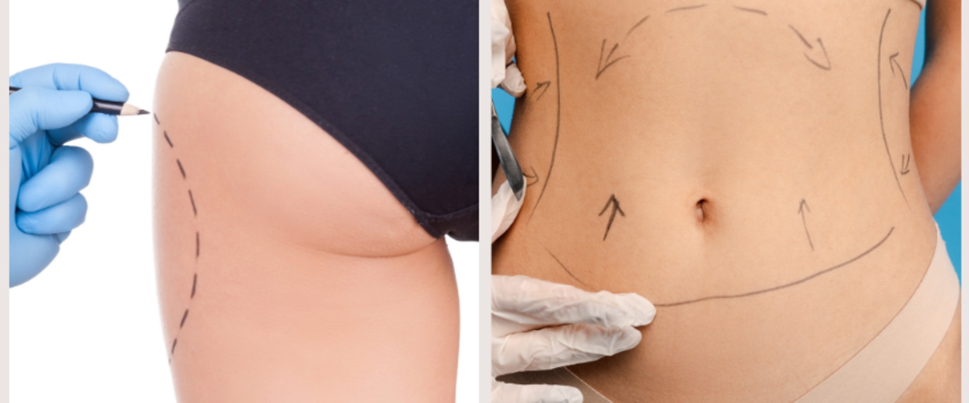 Areas That Can Be Treated with Liposuction