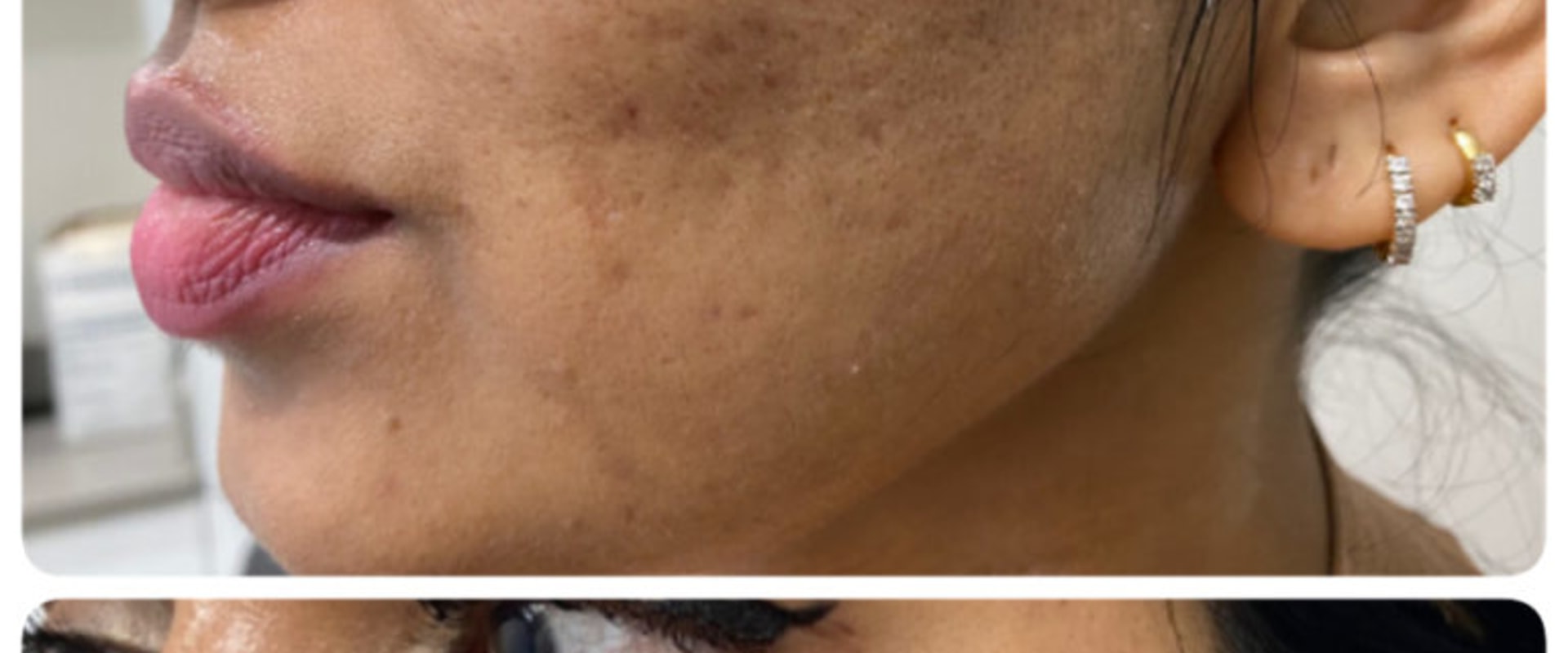 The Amazing Benefits of Laser Skin Resurfacing