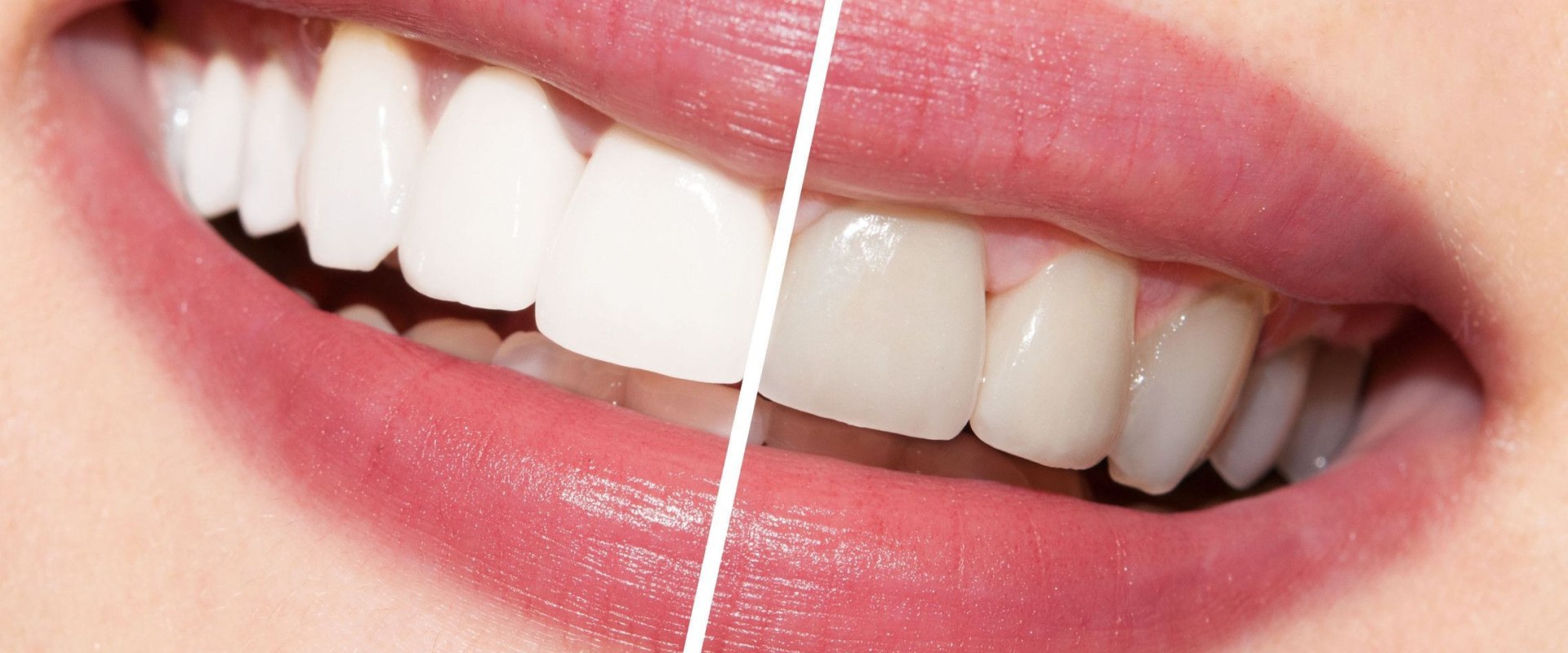 Types of Teeth Whitening Treatments: A Comprehensive Guide for Medical Spa Goers