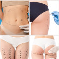 Areas That Can Be Treated with Liposuction