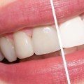 Types of Teeth Whitening Treatments: A Comprehensive Guide for Medical Spa Goers