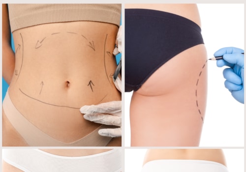 Areas That Can Be Treated with Liposuction