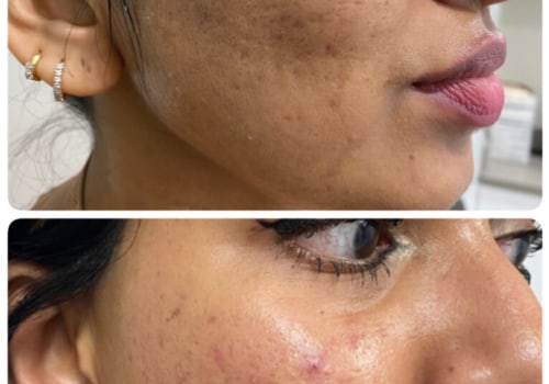 The Amazing Benefits of Laser Skin Resurfacing