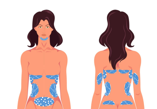 Areas That Can Be Treated With CoolSculpting