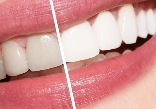 Types of Teeth Whitening Treatments: A Comprehensive Guide for Medical Spa Goers